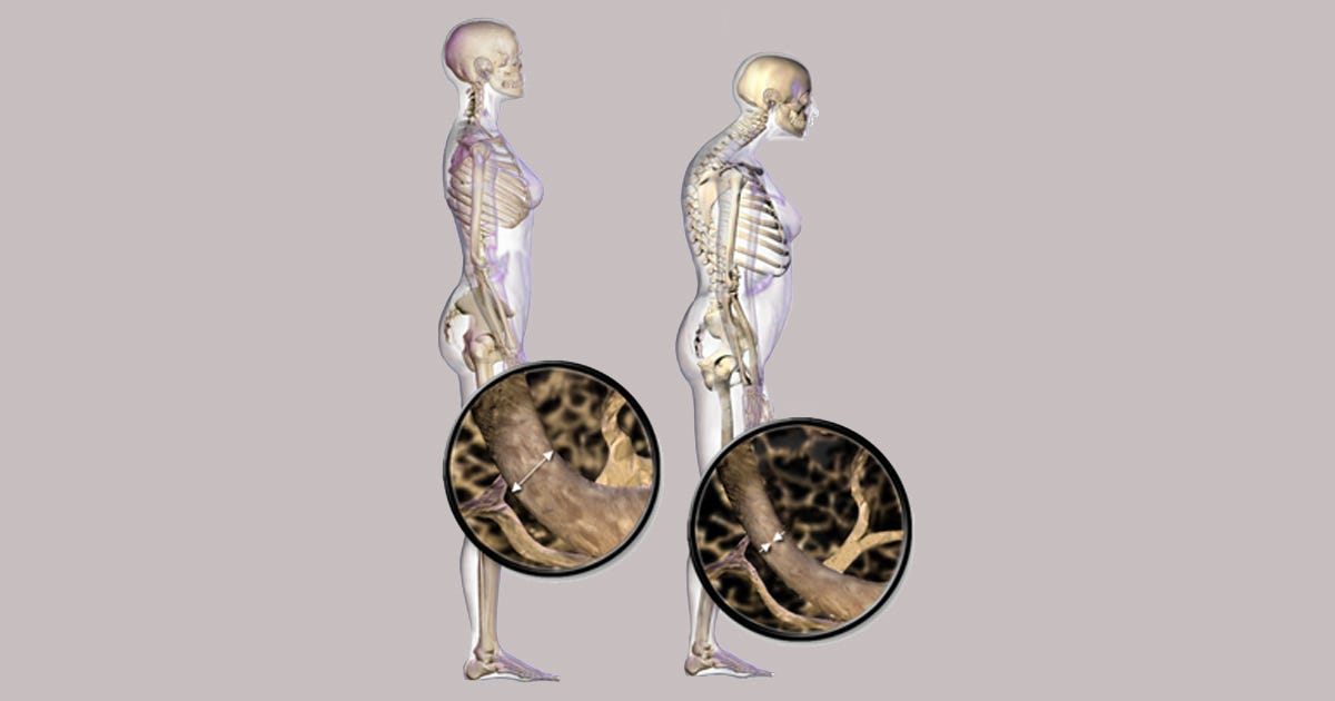 Osteoporose atinge homens e mulheres de maneira diferente, mas exige cuidado para os dois lados Osteoporose atinge homens e mulheres de maneira diferente, mas exige cuidado para os dois lados