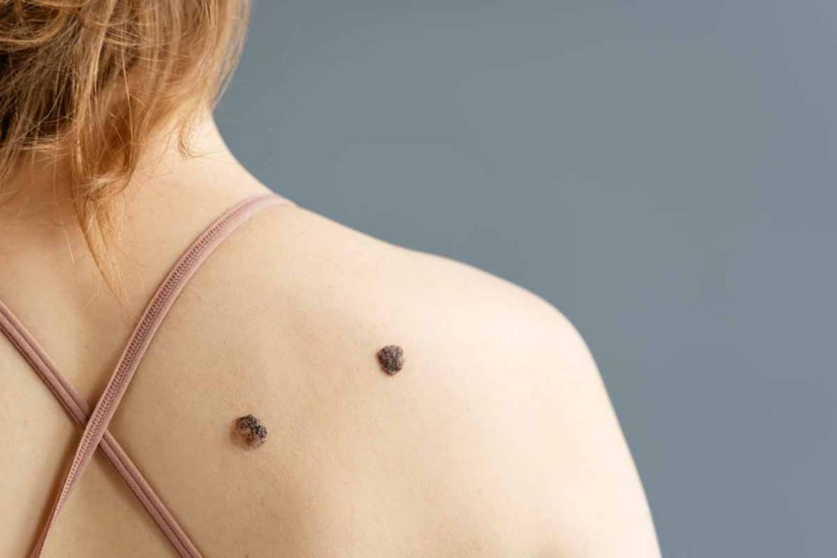 Melanoma - MSD | Spain Melanoma - MSD | Spain