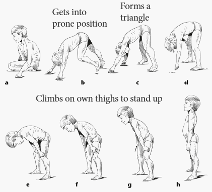 Gower's sign | Epomedicine Gower's sign | Epomedicine