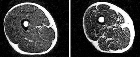 Imaging of sarcopenia - European Journal of Radiology Imaging of sarcopenia - European Journal of Radiology
