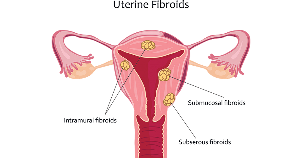 What to Expect If You Have Uterine Fibroids - Preferred Vascular Group
