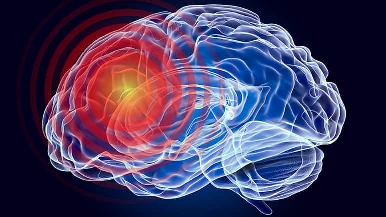 stroke speech comprehension