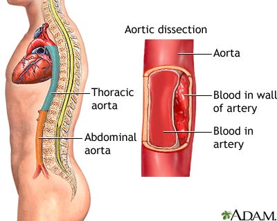 Aortic dissection