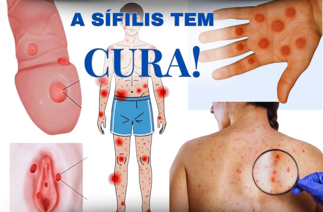 Sífilis: sintomas, tipos, transmissão e tratamento