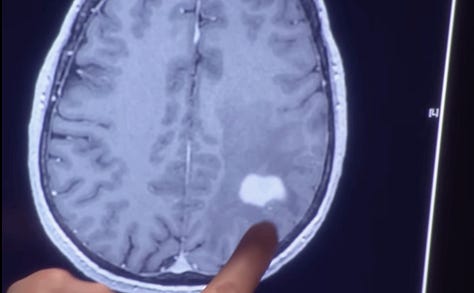 Two images of CT scans showing tumors, and a third image of JP in a hospital bed.