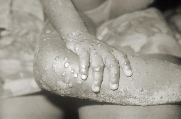 Congo: South Kivu reports more than 3,900 mpox cases this year
