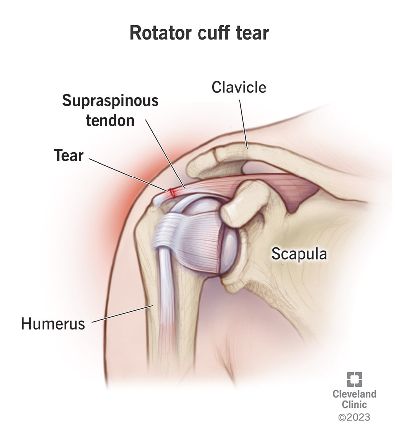 Rotator Cuff Tear: Symptoms & Treatment Rotator Cuff Tear: Symptoms & Treatment