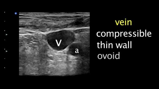 Ultrasound IV's | Student Doctor Network