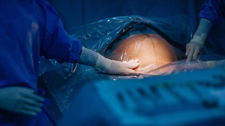 c sections autism