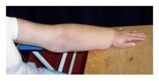 Edema and lymphedema - ОНКОЛОГИЯ. СОВРЕМЕННАЯ ЛИТЕРАТУРА