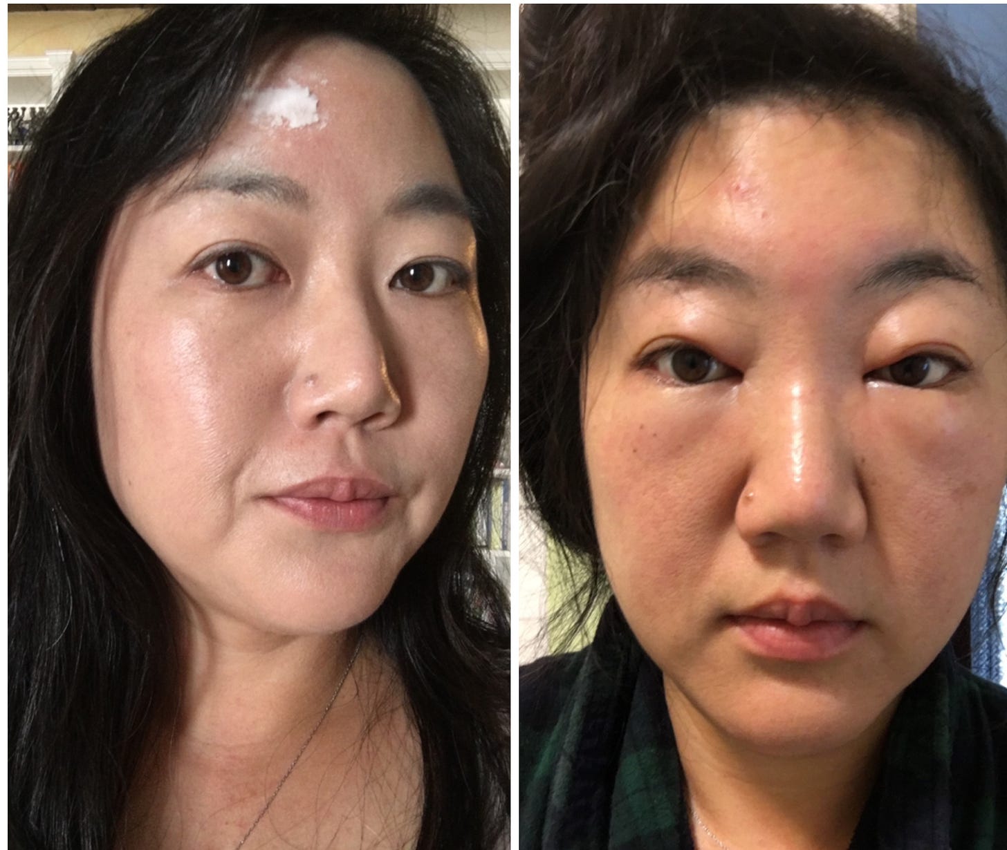 a 2-photo collage, on the left me with a fresh bee sting on my forehead looking chagrined. on the right, 3 days later face puffed up beyond recognition around the eyes and nose a 2-photo collage, on the left me with a fresh bee sting on my forehead looking chagrined. on the right, 3 days later face puffed up beyond recognition around the eyes and nose