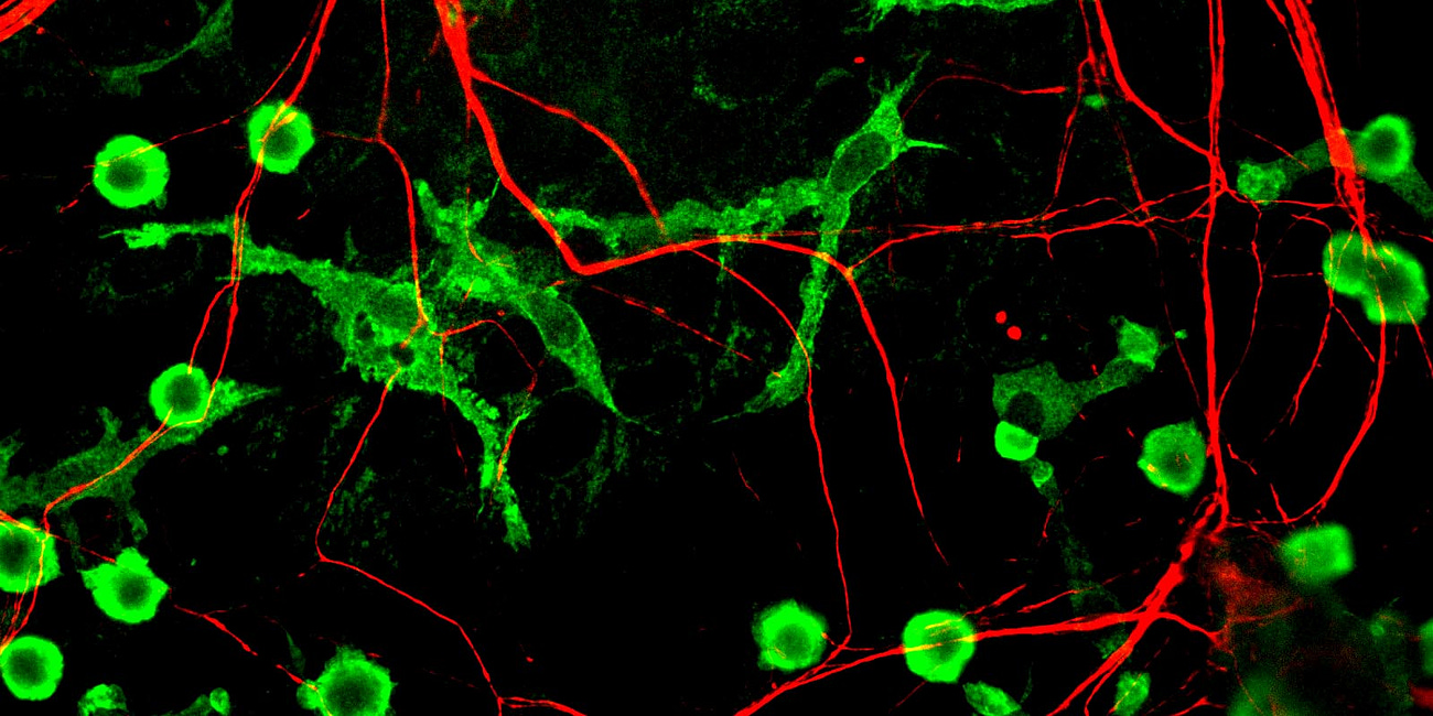 Parkinson's Disease after Pfizer jabs most likely due to Endotoxin in every vial