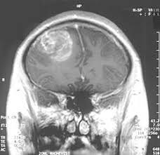 Glioblastoma - Wikipedia Glioblastoma - Wikipedia
