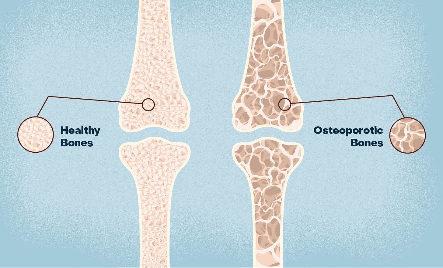 Osteoporosis Treatment - DOC Medical Center