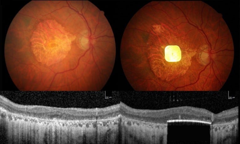 Composite image of scans of the chip in a patient’s eye.