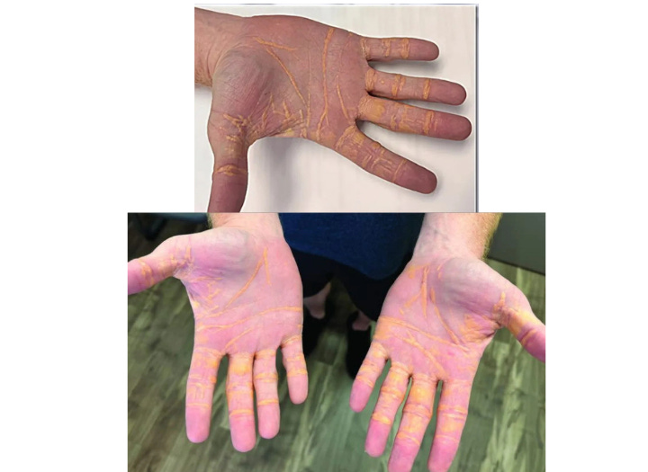 A shocking side effect of extreme cholesterol levels—xanthelasma, or ‘cheese hands,’ caused by a high-fat carnivore diet. This rare condition highlights the dangers of excessive animal fat intake and the benefits of a balanced plant-based diet. A shocking side effect of extreme cholesterol levels—xanthelasma, or ‘cheese hands,’ caused by a high-fat carnivore diet. This rare condition highlights the dangers of excessive animal fat intake and the benefits of a balanced plant-based diet.