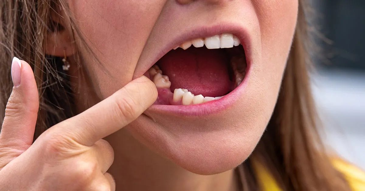 replace missing teeth