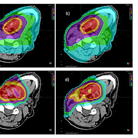 Protons 101: ORIGINAL PUBLICATION, Dysphagia-Optimized Unilateral Proton Radiation Therapy: A Comparative Study Evaluating Constrictor Muscle Dosimetry