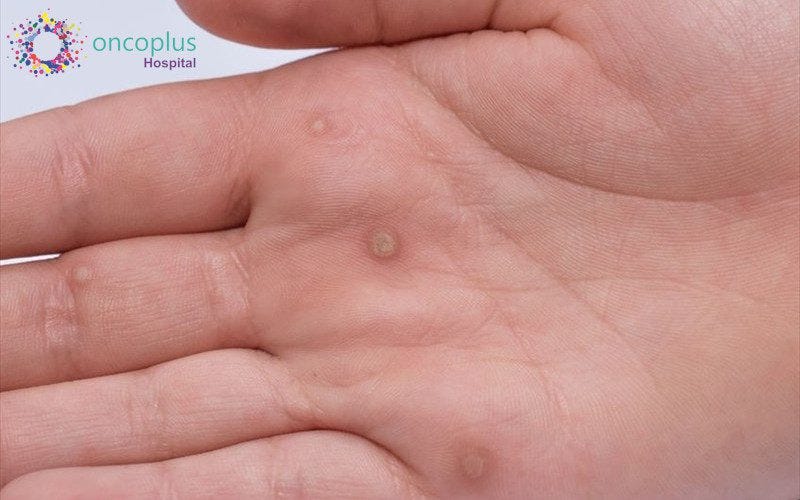 Human Papillomavirus (HPV) Awareness - Oncoplus Hospital Human Papillomavirus (HPV) Awareness - Oncoplus Hospital