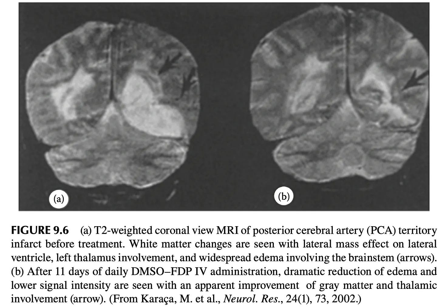 How DMSO Heals The Blood Vessels and Could Save Millions From Strokes