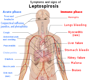 Leptospirosis - Wikipedia