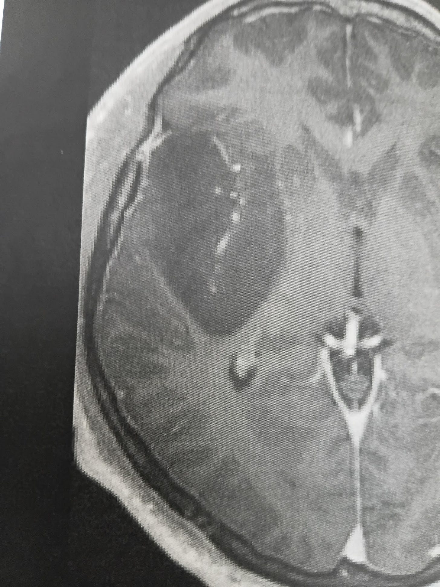 MRI of my brain at the time, shows the hole cut a few days earlier.