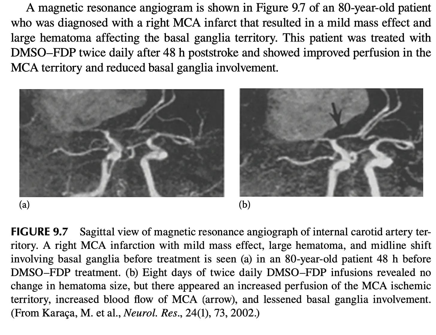 How DMSO Heals The Blood Vessels and Could Save Millions From Strokes
