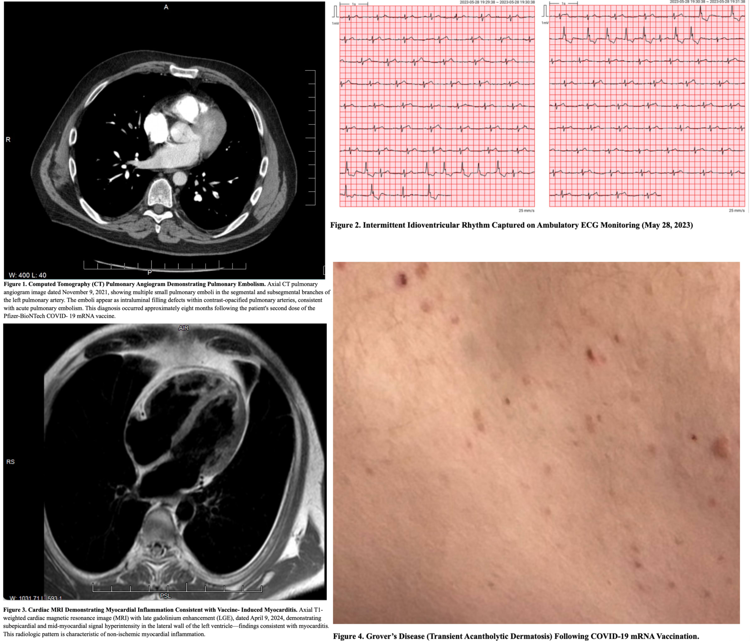 Impfstoff-mRNA, Plasmid-DNA und Spike-Protein können mehr als 3,5 Jahre nach der COVID-19-Impfung im Menschen verbleiben- 3