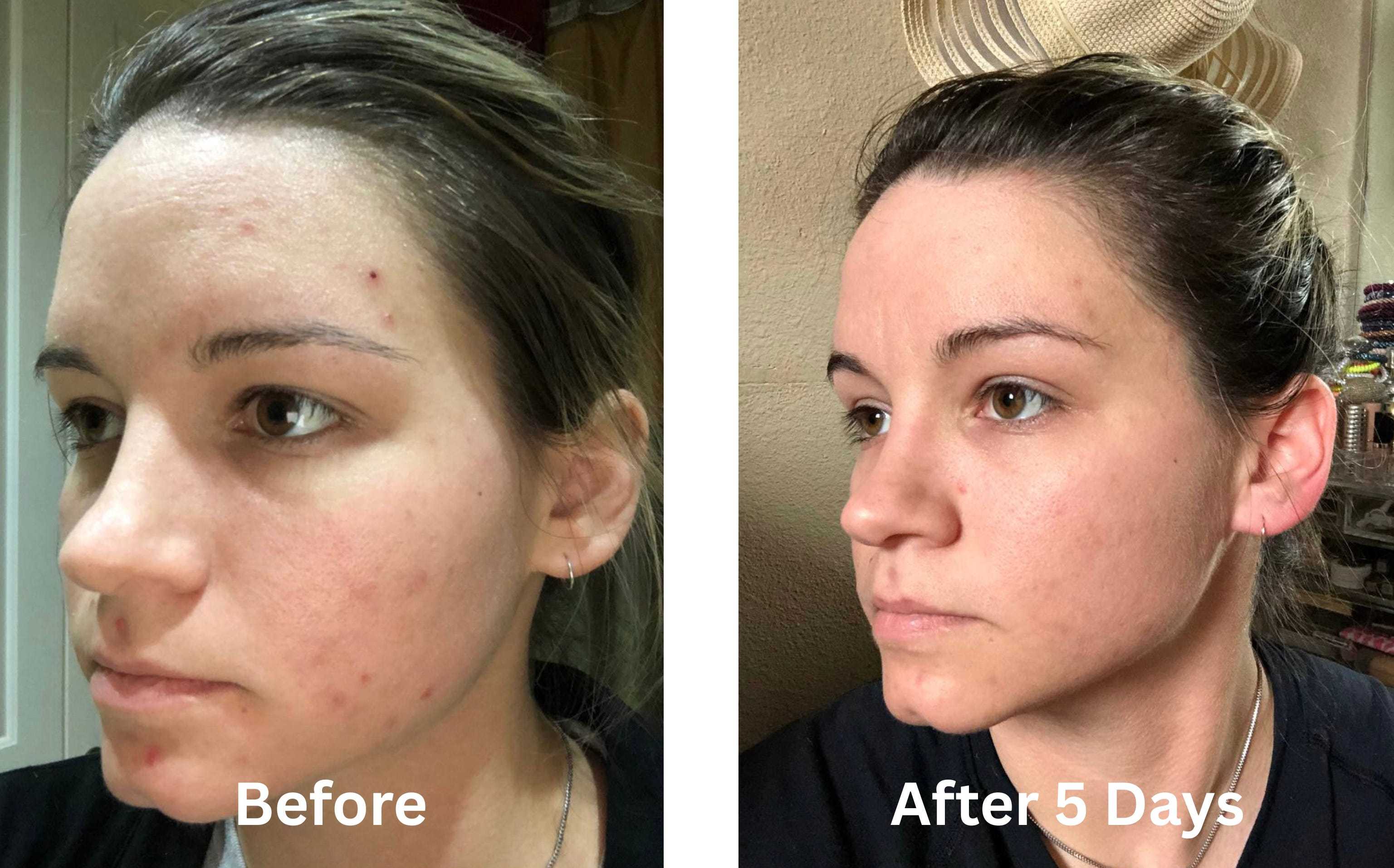 Cure Acne and Eliminate it's Cause With Chlorine Dioxide?