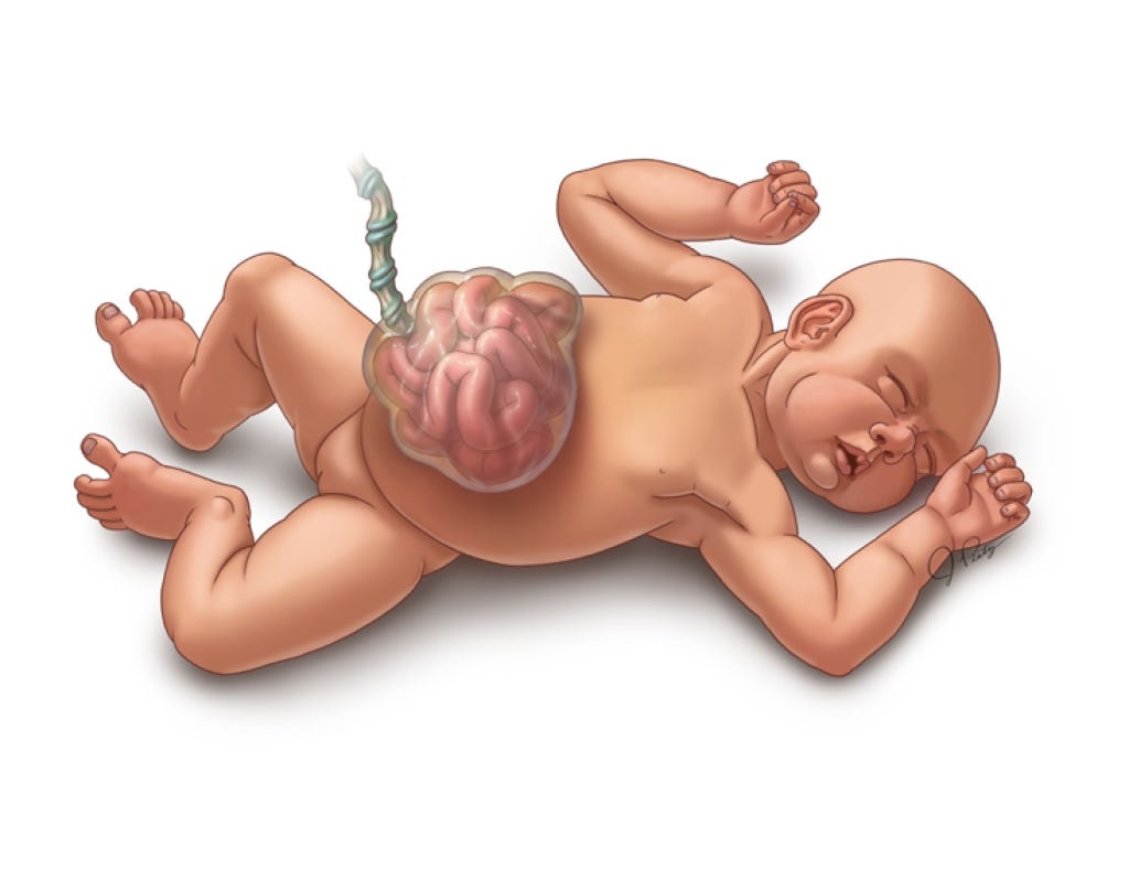 Omphalocele | Texas Children's