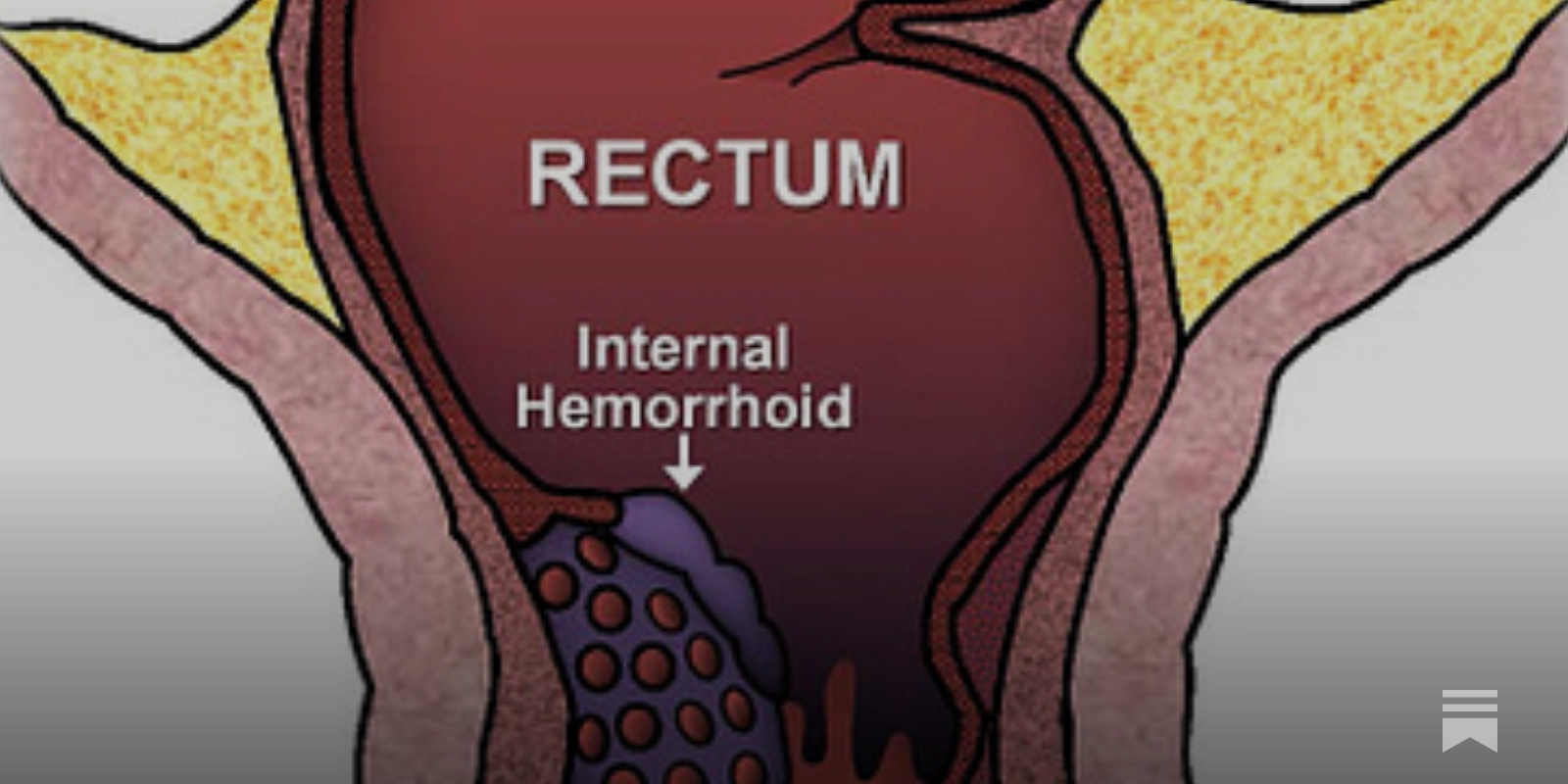 Rectal bleeding: how to approach symptoms that may or may not be related to  having MS