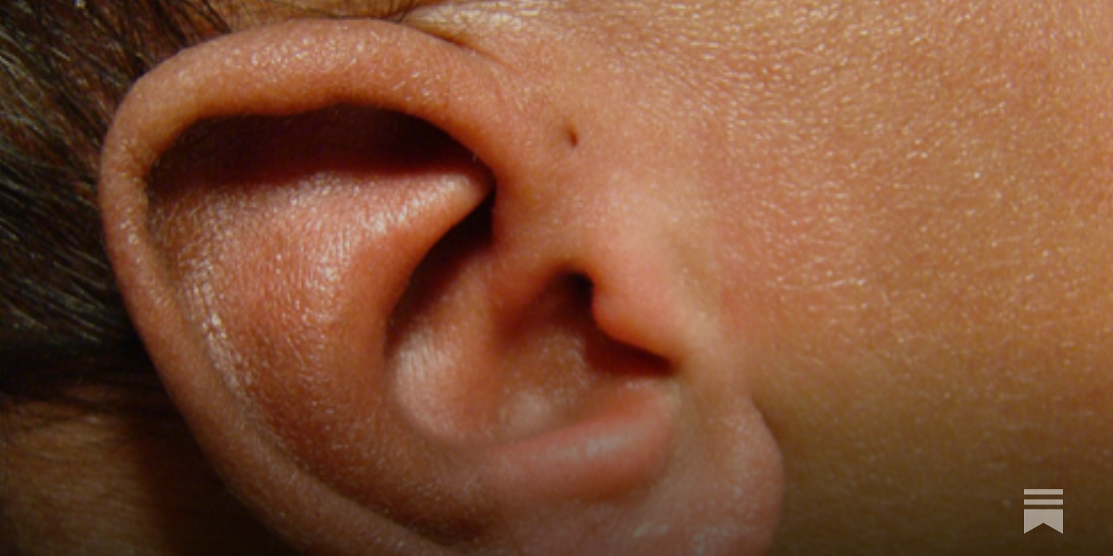 Pediatric Pearls: Infant's Ear - Pits, Tags, and the Pinna