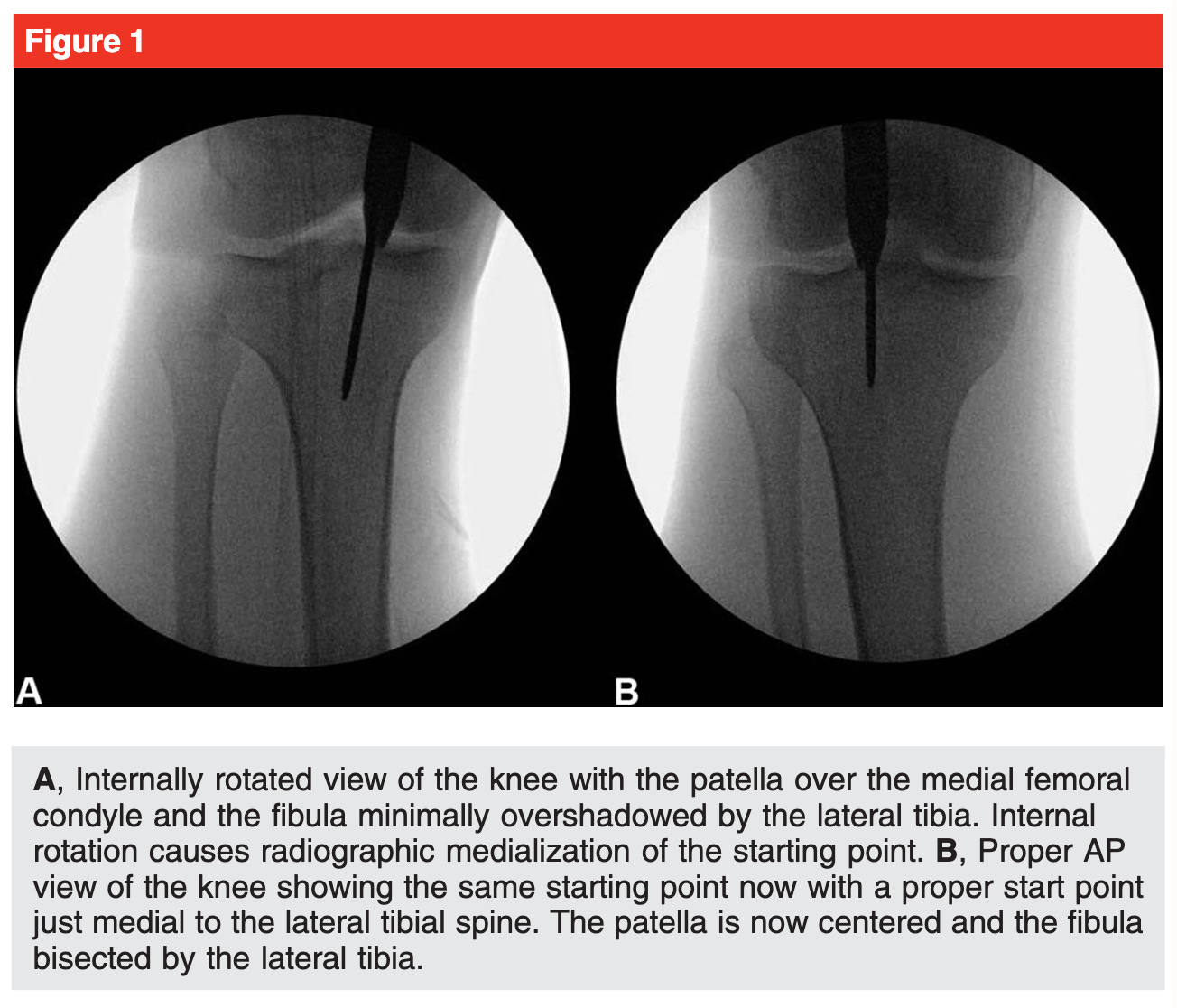 Tibial Shaft Fractures: Intramedullary Nailing | Musculoskeletal Key