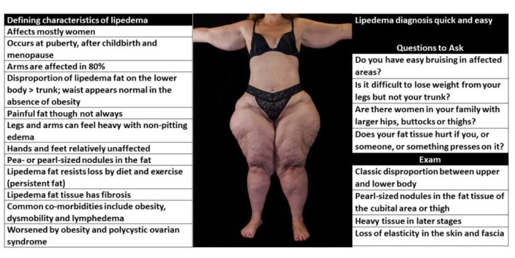 Lipedema - The Disease They Call FAT - Numerous patients with lipedema have  emotional symptoms, for example, being humiliated, discouraged, and  depressed as the lower portion of their body becomes bigger. After