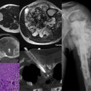 Case 143: Long Parallel Approach to Small Pleural Lesions