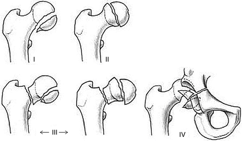 Implant removal  Musculoskeletal Key