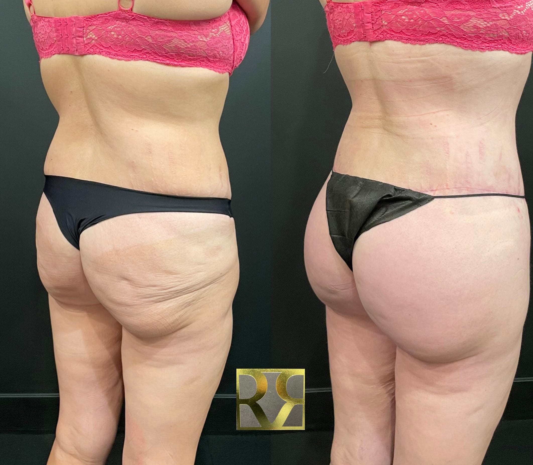 Before & After a Plus Size Tummy Tuck (Dr. Repta) 