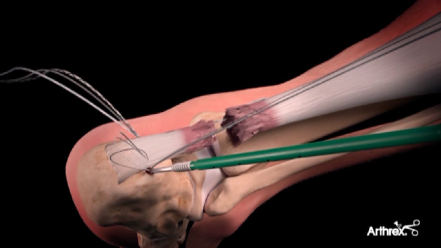 How Aaron Rodgers Is Using An Innovative New Procedure To Speed Up His