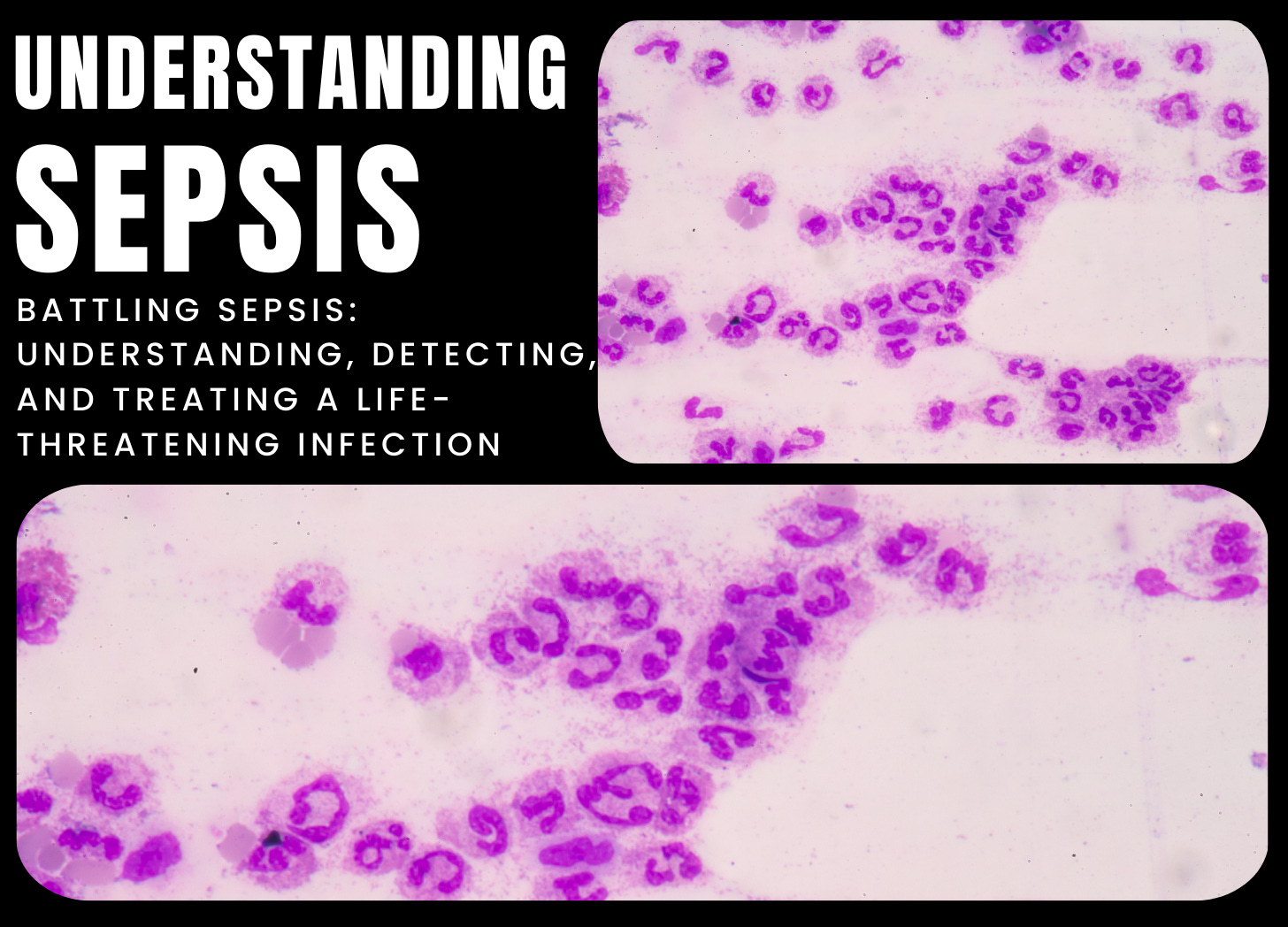 Sepsis: Causes, Symptoms, And Treatment - By Eric Stout