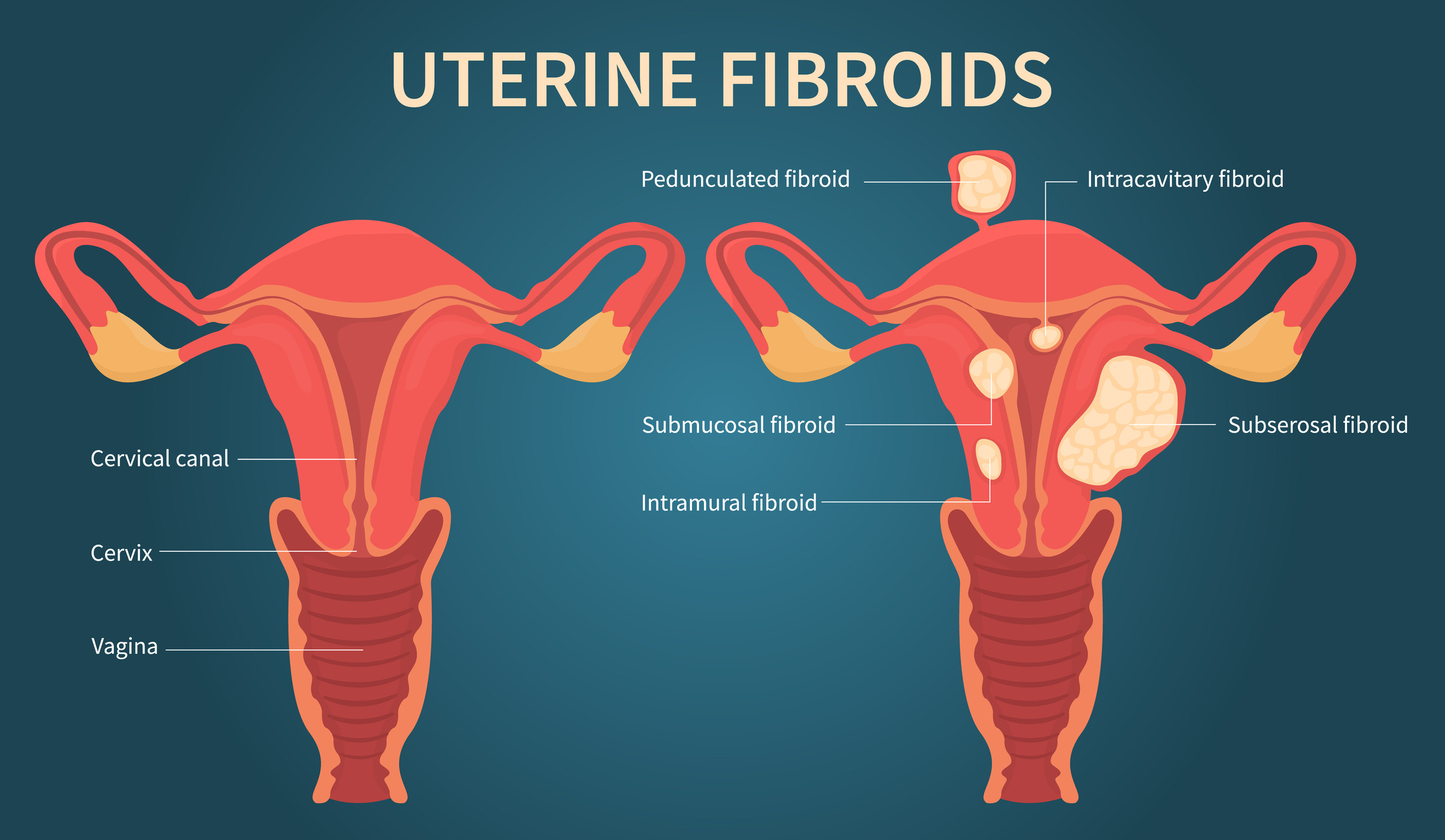Are clots like this always associated with fibroids and/or