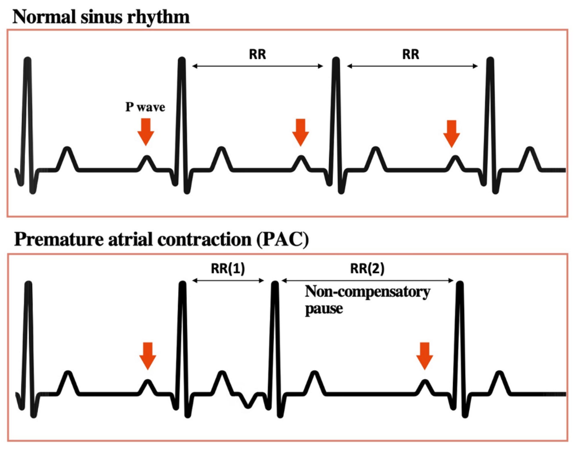 Comparison ECG showing normal sinus rhythm and a premature atrial contraction (PAC) illustrating early P wave and altered RR intervals