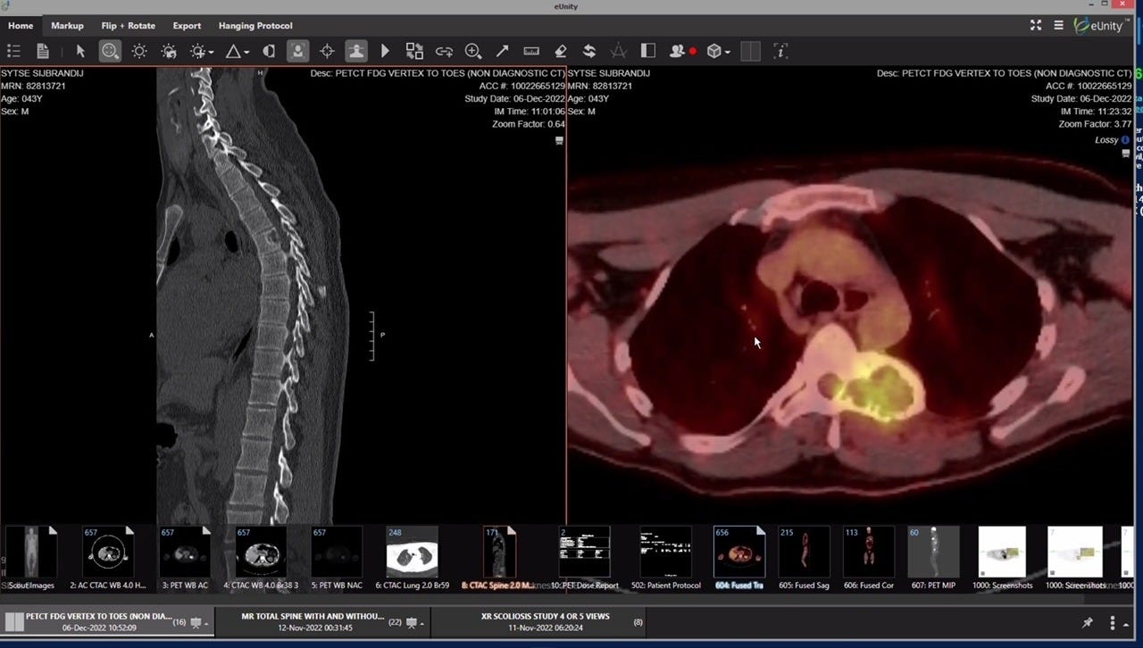 FAP tumor scan showing the tumor lit up in yellow