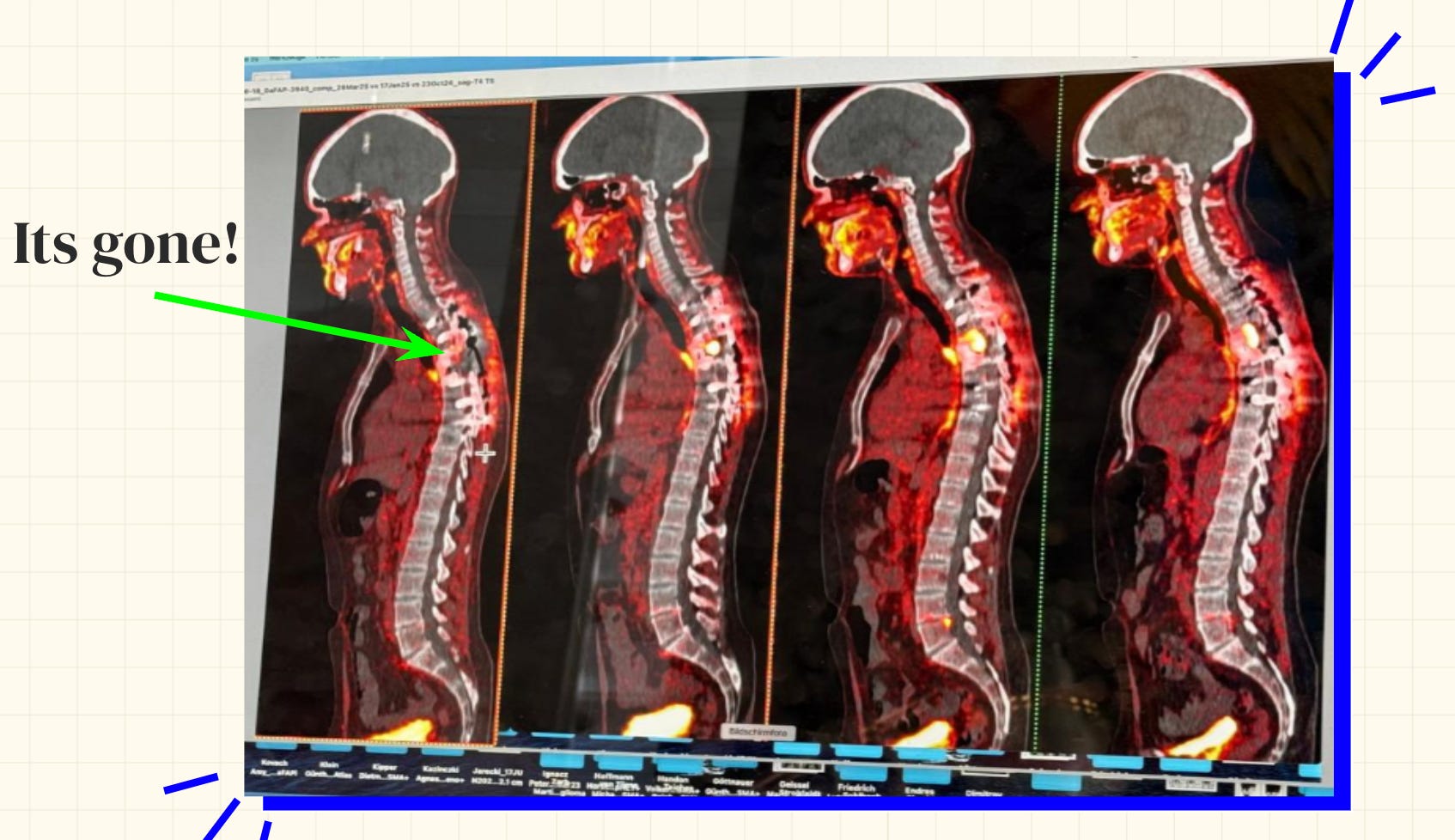 Before and after surgery progression