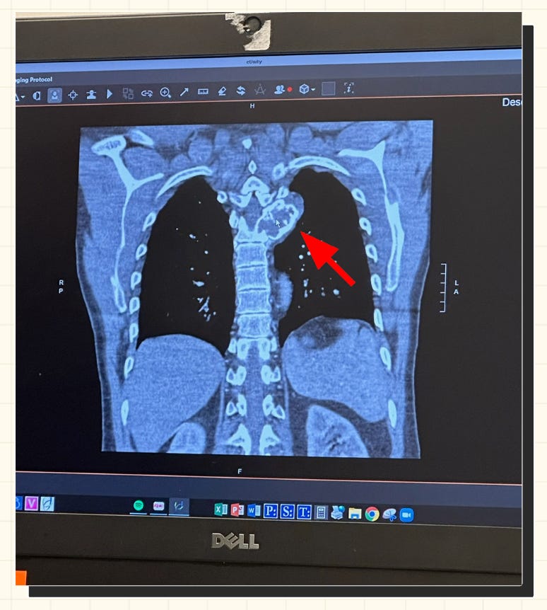 Sid's tumor imaging scan