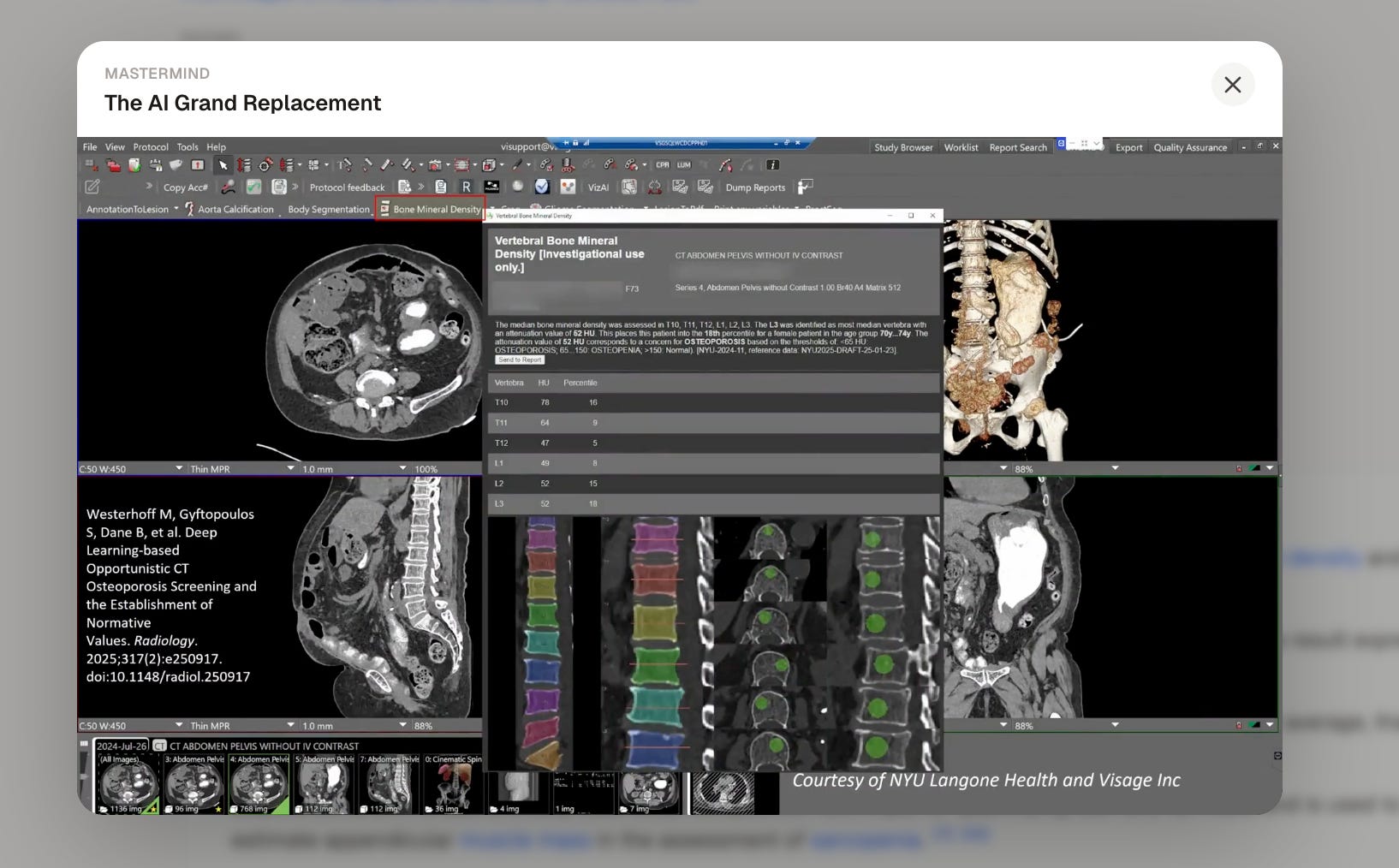 A Mastermind session clip titled The AI Grand Replacement, showing vertebral bone mineral density read from a CT by an AI model, courtesy of NYU Langone Health and Visage Inc