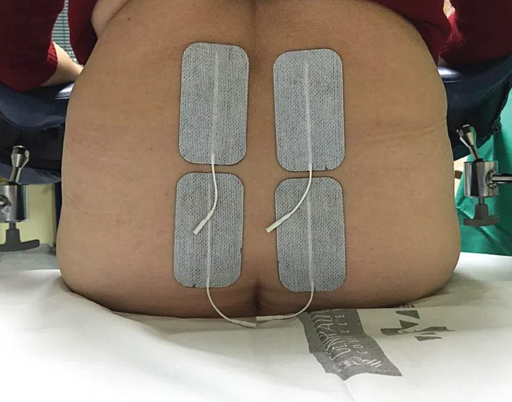 Does electric nerve stimulation work on period pain?