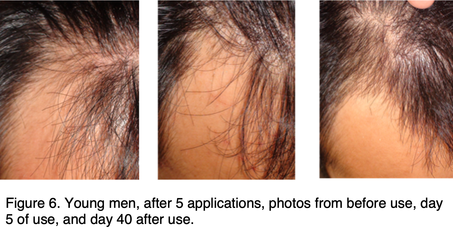 TREATING HAIR LOSS WITH CHLORINE DIOXIDE by Xuewu Liu