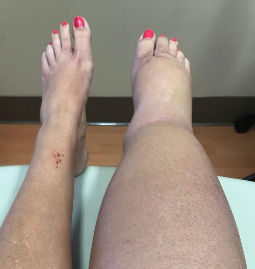 What's the Difference Between Lymphedema and Lipolymphedema?