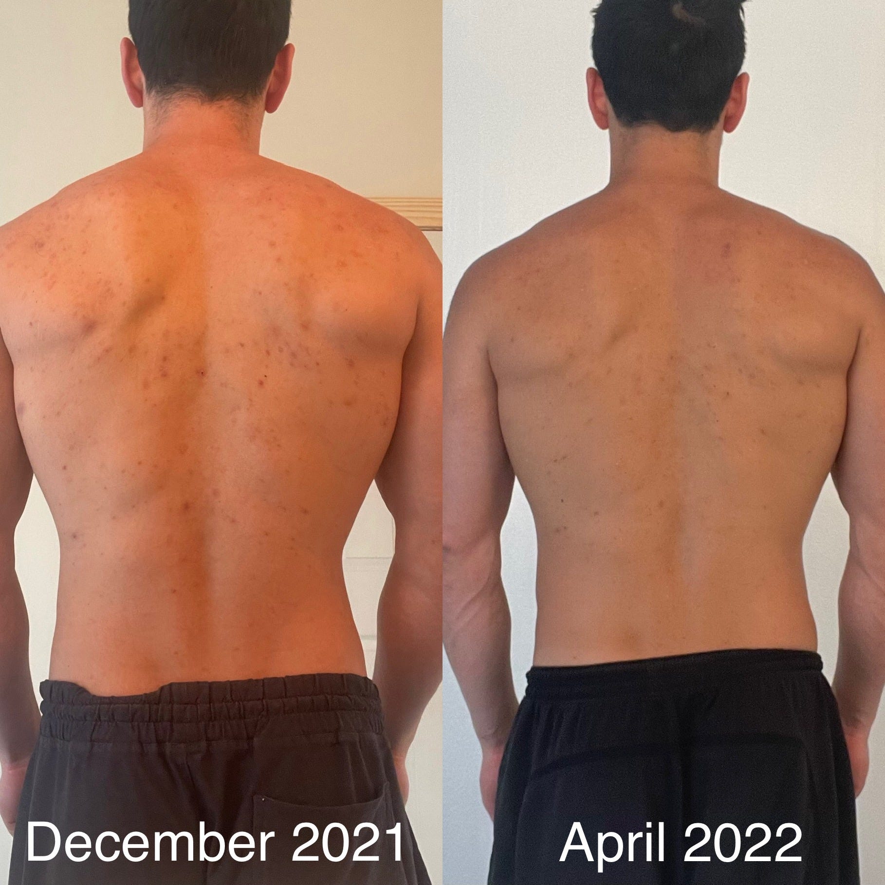 Clearing Back Acne and Hyperpigmentation by BowTiedFawn