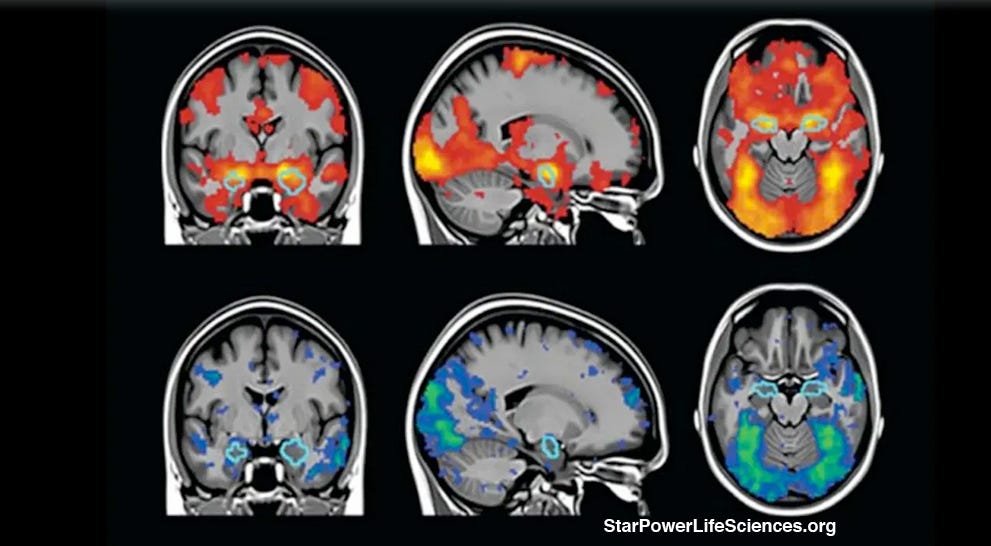 Vitamin D Deficiency Linked to Accelerated Brain Aging